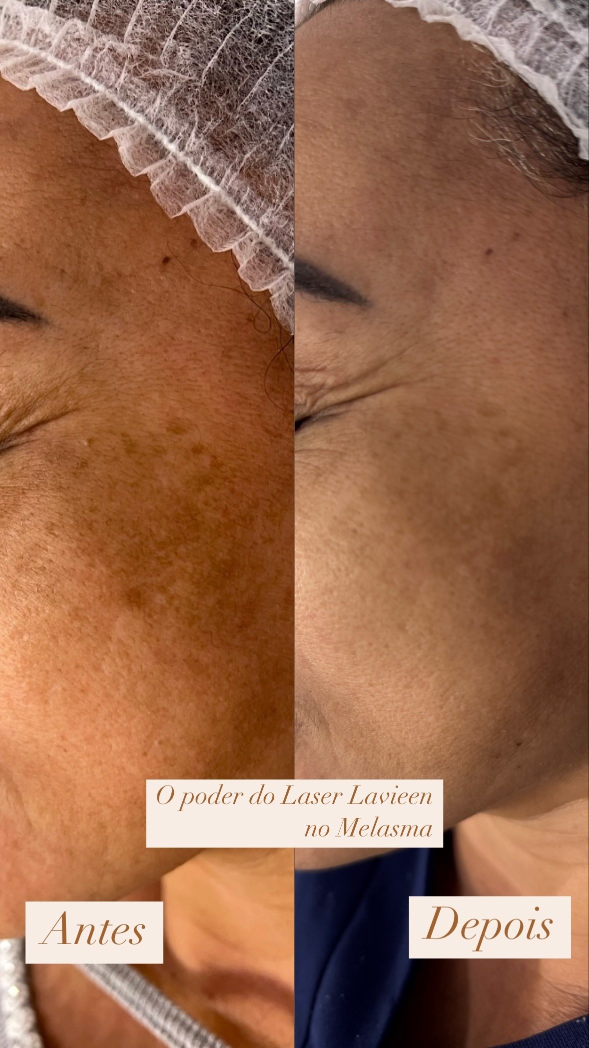 Tratamento de melasma